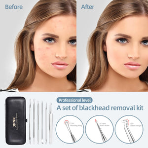jpnk blackhead remover tool comedones extractor acne removal kit for blemish whitehead popping 6 pc zit removing for nose face tools with leather bag