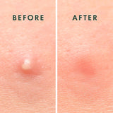 rael pimple patches, hydrocolloid acne spot cover, 2 sizes, korean skin care