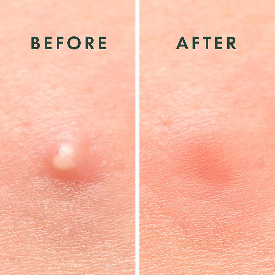 rael pimple patches, hydrocolloid acne spot cover, 2 sizes, korean skin care
